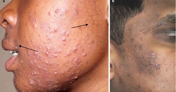 types of acnes in kenya