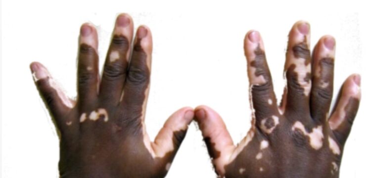 vitiligo in kenya