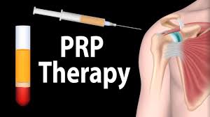 Platelet-Rich Plasma (PRP) therapy